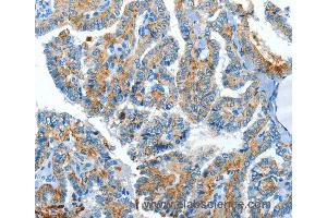 Immunohistochemistry of Human esophagus cancer using CLPTM1L Polyclonal Antibody at dilution of 1:60 (CLPTM1L antibody)
