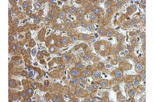 IHC-P Image Immunohistochemical analysis of paraffin-embedded human hepatoma, using alpha-1-Microglobulin, antibody at 1:500 dilution. (AMBP antibody)