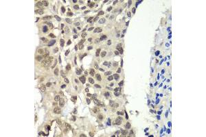 Immunohistochemistry of paraffin-embedded human esophageal cancer using SSRP1 antibody (ABIN6129536, ABIN6148492, ABIN6148494 and ABIN6217711) at dilution of 1:100 (40x lens). (SSRP1 antibody  (AA 1-300))