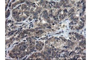 Immunohistochemical staining of paraffin-embedded Adenocarcinoma of Human ovary tissue using anti-DOK7 mouse monoclonal antibody. (DOK7 antibody)