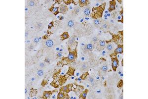 Immunohistochemistry of paraffin-embedded human liver cancer using CYP24 antibody (805) at dilution of 1:200 (40x lens). (CYP24A1 antibody  (AA 36-448))