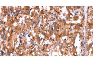 Immunohistochemistry of paraffin-embedded Human thyroid cancer tissue using GCG Polyclonal Antibody at dilution 1:40 (Glucagon antibody)