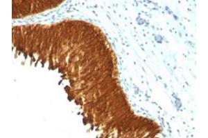 Immunohistochemical staining (Formalin-fixed paraffin-embedded sections) of human bladder carcinoma with Cytokeratin monoclonal antibody, clone KRT/457 . (KRT4 antibody)