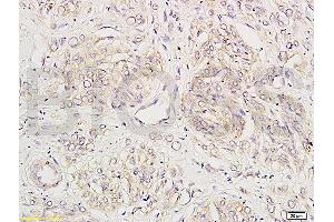 Formalin-fixed and human breast carcinoma tissue labeled with Anti-KLK1 Polyclonal Antibody (ABIN675983), Unconjugated at 1:200 followed by conjugation to the secondary antibody and DAB staining