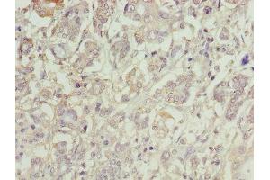 Immunohistochemistry of paraffin-embedded human pancreatic cancer using ABIN7147039 at dilution of 1:100 (Cation Channel Sperm-Associated Protein Subunit epsilon (CATSPERE) (AA 601-832) antibody)