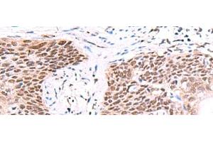 Immunohistochemistry of paraffin-embedded Human esophagus cancer tissue using IRF2BP1 Polyclonal Antibody at dilution of 1:40(x200) (IRF2BP1 antibody)