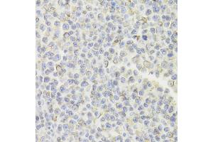 Immunohistochemistry of paraffin-embedded human B cell lymphoma using CD74 Antibody (ABIN5973310) at dilution of 1/100 (40x lens).