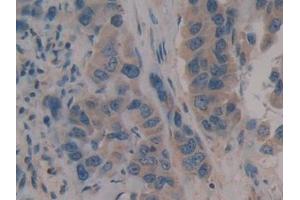 Detection of CD109 in Human Breast cancer Tissue using Polyclonal Antibody to Cluster Of Differentiation 109 (CD109) (CD109 antibody  (AA 1146-1390))
