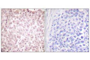 Immunohistochemical analysis of paraffin-embedded human breast carcinoma tissue using RCC1 antibody (ABIN5976498). (RCBTB1 antibody  (Internal Region))