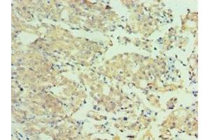 Immunohistochemistry of paraffin-embedded human colon cancer using ABIN7160651 at dilution of 1:100