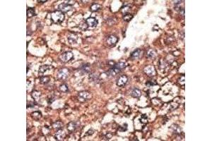 IHC analysis of FFPE human hepatocarcinoma tissue stained with the Leptin Receptor antibody (Leptin Receptor antibody  (AA 23-52))