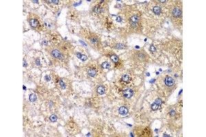 Immunohistochemistry of paraffin-embedded Human liver damage using AMY2A Polyclonal Antibody at dilution of 1:100 (40x lens). (AMY2A antibody)