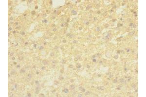 Immunohistochemistry of paraffin-embedded human glioma using ABIN7173241 at dilution of 1:100