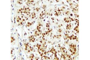 IHC-P: CTBP2 antibody testing of human breast cancer tissue