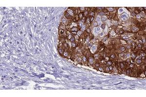 ABIN6269007 at 1/100 staining Human urothelial cancer tissue by IHC-P. (GRM8 antibody  (C-Term))