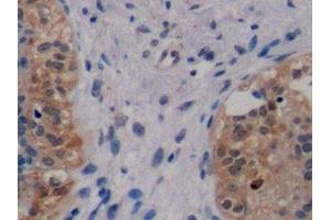 Detection of ErbB2 in Human Breast cancer Tissue using Monoclonal Antibody to Receptor Tyrosine Protein Kinase erbB-2 (ErbB2) (ErbB2/Her2 antibody  (AA 376-578))