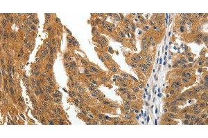 Immunohistochemistry of paraffin-embedded Human ovarian cancer tissue using BIRC6 Polyclonal Antibody at dilution 1:30 (BIRC6 antibody)