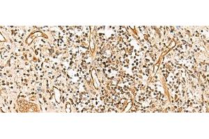 Immunohistochemistry of paraffin-embedded Human prost ate cancer tissue using HUS1 Polyclonal Antibody at dilution of 1:65(x200) (HUS1 antibody)