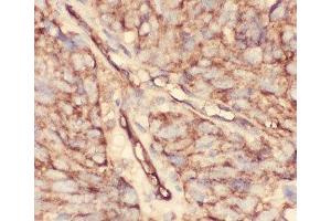 IHC-P: CD34 antibody testing of human lung cancer tissue (CD34 antibody  (AA 151-385))