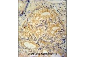 C antibody (N-term) (ABIN654965 and ABIN2844604) immunohistochemistry analysis in formalin fixed and paraffin embedded human prostate carcinoma followed by peroxidase conjugation of the secondary antibody and DAB staining. (C16ORF13 antibody  (N-Term))