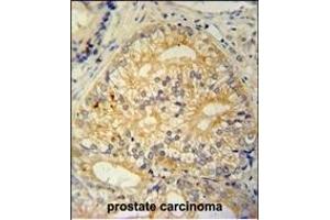C antibody (N-term) (ABIN654965 and ABIN2844604) immunohistochemistry analysis in formalin fixed and paraffin embedded human prostate carcinoma followed by peroxidase conjugation of the secondary antibody and DAB staining. (C16ORF13 antibody  (N-Term))
