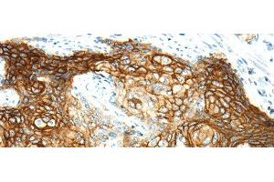 Immunohistochemistry of paraffin-embedded Human cervical cancer using AQP3 Polyclonal Antibody at dilution of 1/30 (AQP3 antibody)