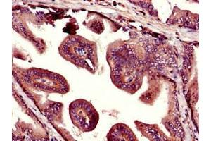 Immunohistochemistry of paraffin-embedded human prostate tissue using ABIN7169055 at dilution of 1:100 (UHMK1 antibody  (AA 183-385))