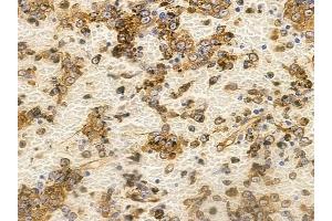 ABIN6265801 and ABIN6266839 at 1/100 staining human melanoma by IHC-P. (alpha Tubulin antibody  (C-Term))