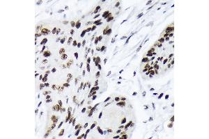 Immunohistochemistry of paraffin-embedded human esophageal cancer using A Rabbit mAb (ABIN7265699) at dilution of 1:100 (40x lens). (ARID1A antibody)