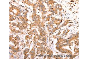 Immunohistochemistry of Human lung cancer using CELSR2 Polyclonal Antibody at dilution of 1:50 (CELSR2 antibody)