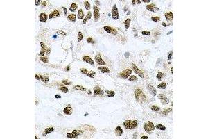 Immunohistochemical analysis of MCM6 staining in human lung cancer formalin fixed paraffin embedded tissue section. (MCM6 antibody)