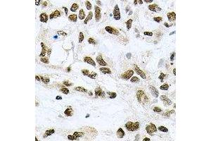 Immunohistochemical analysis of MCM6 staining in human lung cancer formalin fixed paraffin embedded tissue section.