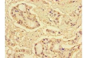 Immunohistochemistry of paraffin-embedded human pancreatic cancer using ABIN7166091 at dilution of 1:100 (MBTPS1 antibody  (AA 17-70))
