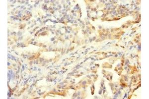 Immunohistochemistry of paraffin-embedded human lung cancer using ABIN7155913 at dilution of 1:100 (HCFC1R1 antibody  (AA 1-119))