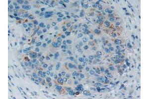 IHC-P analysis of Human Liver CancerTissue, with DAB staining. (SMAD5 antibody  (AA 210-464))