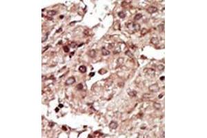 Formalin-fixed and paraffin-embedded human cancer tissue (hepatocarcinoma) reacted with the primary antibody, which was peroxidase-conjugated to the secondary antibody, followed by AEC staining. (PHKG1 antibody  (Middle Region))