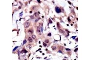 IHC analysis of FFPE human breast carcinoma tissue stained with the MUSK antibody (MUSK antibody  (AA 35-65))