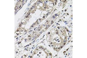 Immunohistochemistry of paraffin-embedded human gastric cancer using Carbonic Anhydrase 9 (C/G250) antibody (ABIN6131266, ABIN6137798, ABIN6137800 and ABIN6217767) at dilution of 1:100 (40x lens). (CA9 antibody  (AA 52-151))