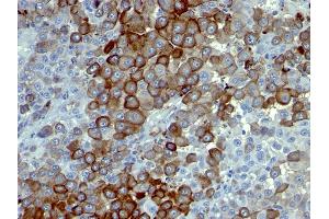 Formalin-fixed, paraffin-embedded human Melanoma stained with NGFR Monoclonal Antibody (NTR/912). (NGFR antibody)