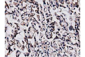 Immunohistochemical staining of paraffin-embedded Adenocarcinoma of Human colon tissue using anti-OGFOD1 mouse monoclonal antibody. (OGFOD1 antibody)