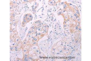 Immunohistochemistry of Human breast cancer using ADAMTS14 Polyclonal Antibody at dilution of 1:50 (ADAMTS14 antibody)