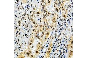 Immunohistochemical analysis of POLR3B staining in human lung cancer formalin fixed paraffin embedded tissue section. (POLR3B antibody)
