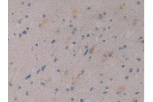 Detection of DKK3 in Human Glioma Tissue using Polyclonal Antibody to Dickkopf Related Protein 3 (DKK3) (DKK3 antibody  (AA 22-350))