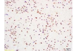 Formalin-fixed and paraffin embedded human brain glioblastoma labeled with Rabbit Anti YBX-1/YB1 Polyclonal Antibody, Unconjugated (ABIN759851) at 1:200 followed by conjugation to the secondary antibody and DAB staining (YBX1 antibody)