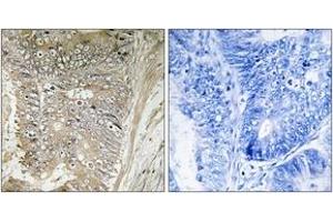 Immunohistochemistry analysis of paraffin-embedded human colon carcinoma tissue, using RPL37A Antibody.