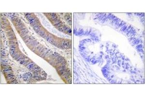 Immunohistochemistry analysis of paraffin-embedded human colon carcinoma tissue, using p47 phox (Ab-359) Antibody. (NCF1 antibody  (AA 331-380))