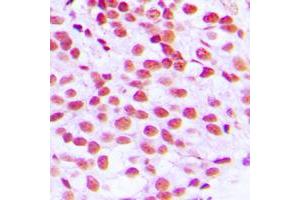 Immunohistochemical analysis of ELK1 staining in human breast cancer formalin fixed paraffin embedded tissue section.