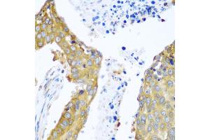 Immunohistochemistry of paraffin-embedded human lung cancer using YBX1 antibody. (YBX1 antibody)