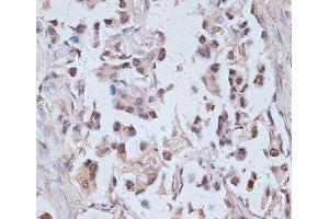 Immunohistochemistry of paraffin-embedded Human lung cancer using TAX1BP1 Polyclonal Antibody at dilution of 1:100 (40x lens).