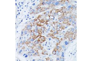 Immunohistochemistry of paraffin-embedded human liver cancer using MANBA antibody (ABIN7268392) at dilution of 1:100 (40x lens). (MANBA antibody  (AA 18-300))